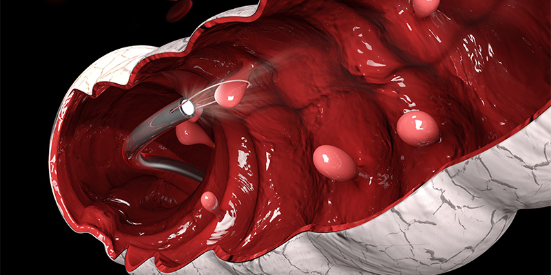 Early-cancer-polyp-removals